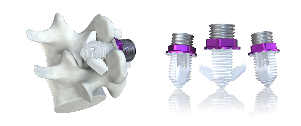 Spinal Simplicity Minuteman lateral lumbar interbody fusion
